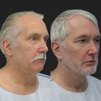 Before and after result