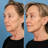 Before and after result